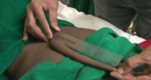 Inde: un garçon opéré pour se faire retirer une "queue" de 18 cm dans le dos