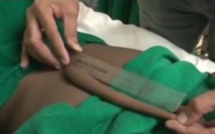 Inde: un garçon opéré pour se faire retirer une "queue" de 18 cm dans le dos